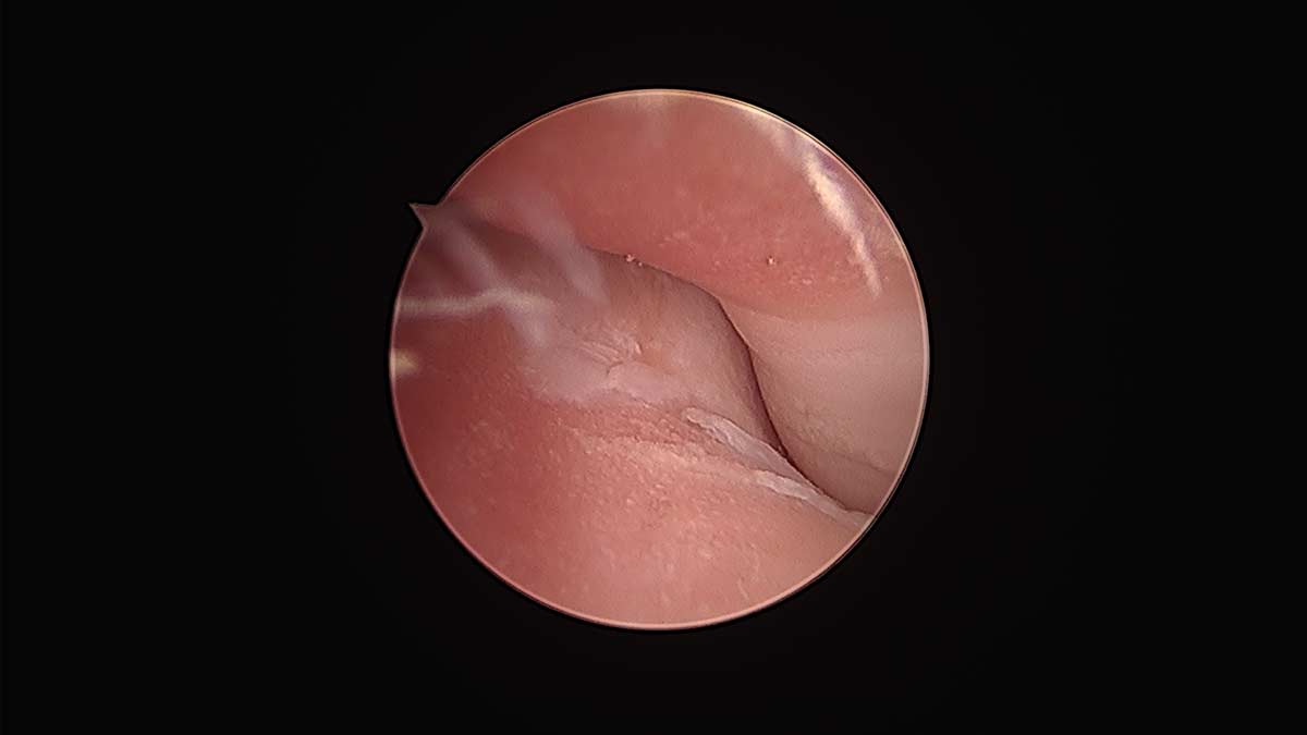 arthroscopic medial compartment syndrome